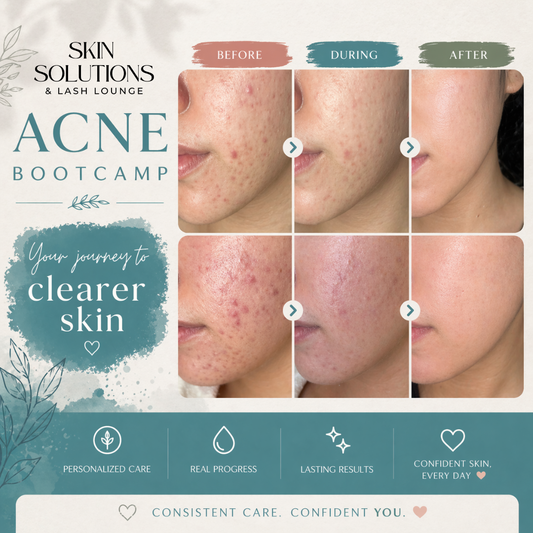 Adult Acne in Your 30s, 40s, and 50s: Why It Happens and How to Treat It