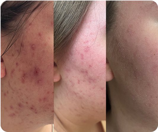Face Reality Acne Boot Camp | Certified Acne Specialist in Gilbert & Mesa, AZ