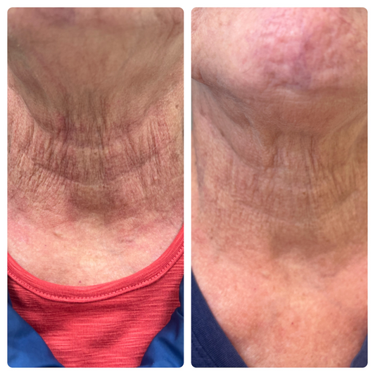 “Microneedling Benefits at Every Age”